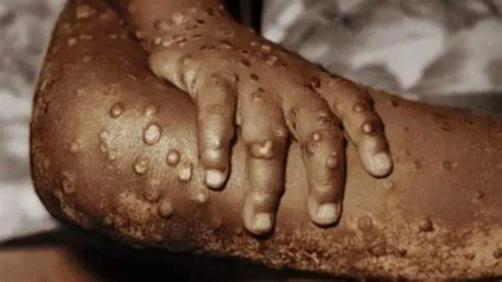 40 Mpox Cases Recorded in 19 States.