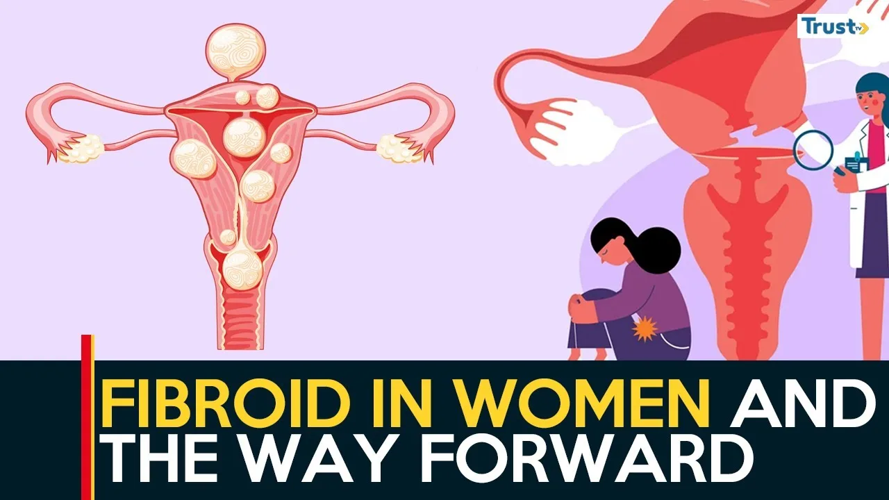 Fibroids in women and the way forward 