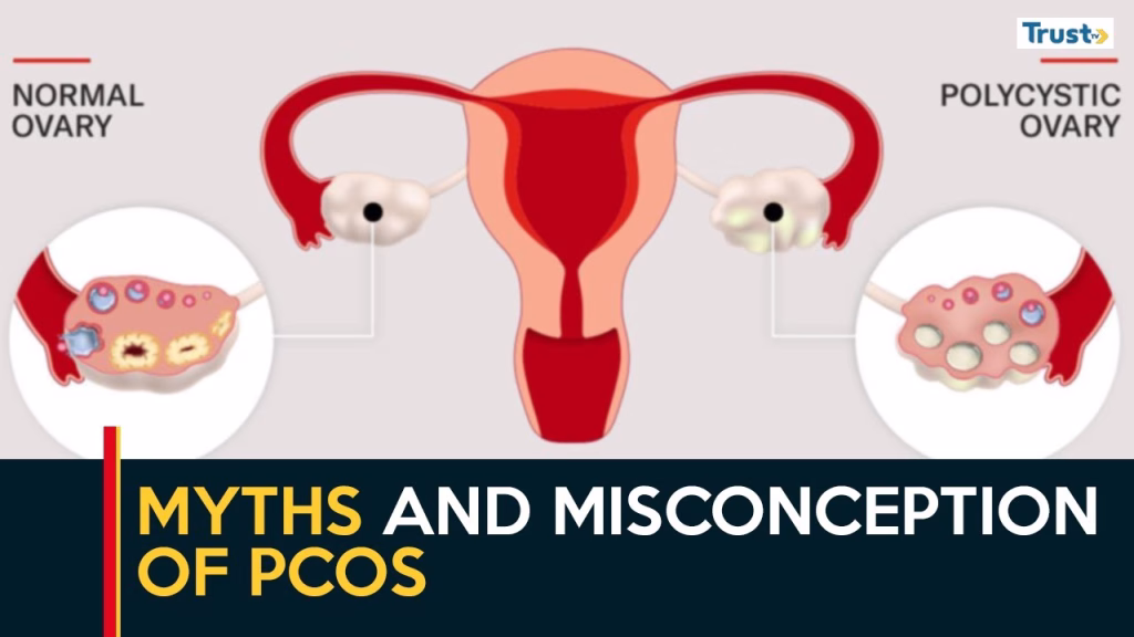 Myths and misconception of PCOS 